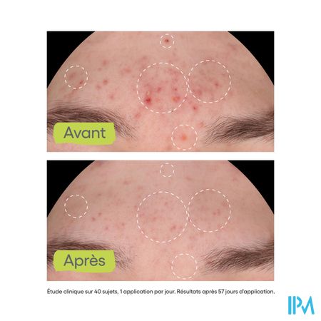 Aderma Biology Ac Night Peel Serum A/imperf. 30ml 5